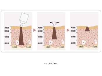 ミウル 天王寺店(miulu)/ミウルのシミケア照射♪