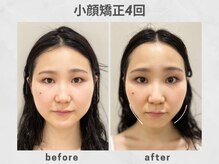 ビトリア 横浜店(BITORIA)の雰囲気（横幅、ほうれい線、むくみ、フェイスラインの改善など）