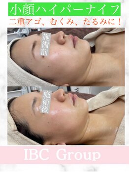 トータルサロンアイビーシー(トータルサロンIBC)/ハイパーナイフ小顔フェイシャル
