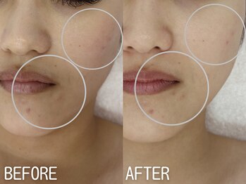 イエローウィーン(YELLOWEEN.)/肌の色ムラ原因になるニキビ