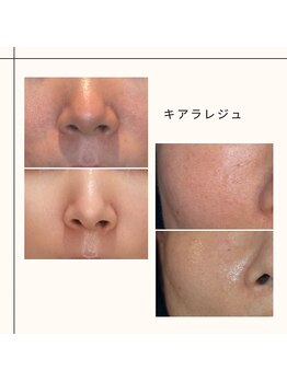 シベール(Si belle)の写真/そのハリ不足、諦めないで！韓国肌管理で目指すツヤ肌