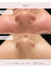 エミル(Emillu)/＊facial_ビフォーアフター