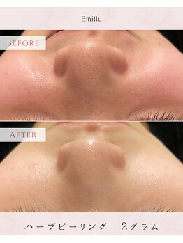 エミル(Emillu)/＊facial_ビフォーアフター