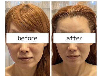 ビューティーサロン リリー(Lily)/フェイスラインアップ小顔効果