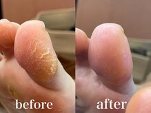 ドクターネイル爪革命 札幌本店/症例紹介２４　たこ