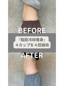 ひなた(salon)/脂肪冷却痩身ビフォーアフター