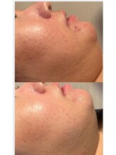 サロンドエムジョリー 横浜(Salon de M jolie)/ニキビや赤みケアは断然◯ピール