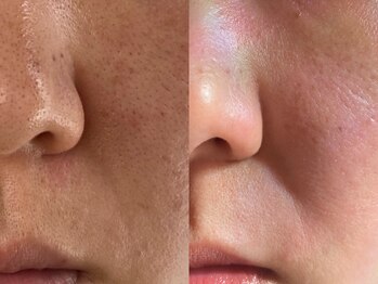 eyebrow salon forme. 【フォルメ】の写真/【毛穴ケアで透明感UP】フェイシャルワックスで産毛・古い角質をケアし、なめらかな素肌へ導きます♪