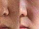eyebrow salon forme. 【フォルメ】の写真/【毛穴ケアで透明感UP】フェイシャルワックスで産毛・古い角質をケアし、なめらかな素肌へ導きます♪