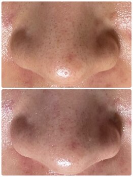 エミニティ トータルビューティーサロン(Eminity)/ハイドロフェイシャル毛穴