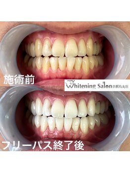 ホワイトニングサロン 京都烏丸店/ホワイトニング施術例