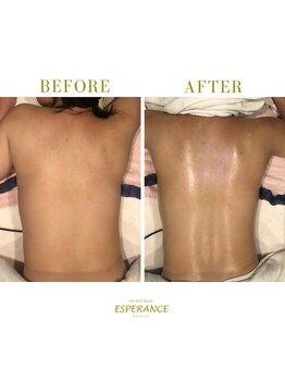 エステティックサロン エスぺランス(ESPERANCE)/背中のむくみも解消へ！