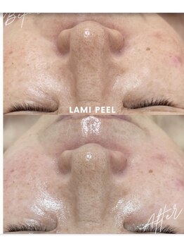 リラクゼーションアンドビューティーボヌール(BONHENR)/ラミネーションピールの効果