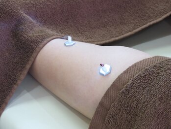 小台尾久はりきゅう整体院/灸施術