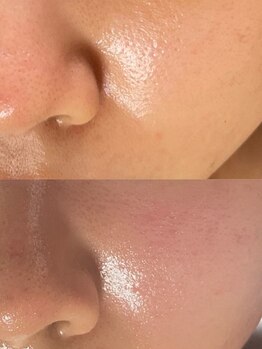 ユウビ ビューティー サロン(Yuubi)/【peel stage】ハーブピーリング