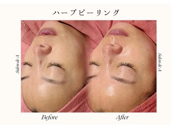 サロンドエー 帝塚山(Salon de A)/ハーブピーリング