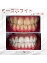ミースホワイトニング(mys whitening)/ビフォーアフター【歯科提携】