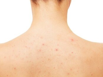 オルディーネ(ORUDiNE)の写真/【挙式を最高の美肌で】背中のニキビ・顔のたるみも改善！再生美容の土台ケアで360度自信の持てる姿へ