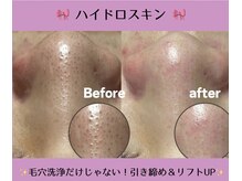 サロンリアンジュ ひたちなか店(Salon Liange)/【毛穴洗浄◇引き締めまで◎】