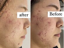 エレン(Elen)/【肌質改善】ハーブピーリング