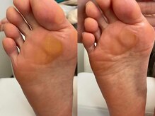 キラネイル アンド アイラッシュ by World Beauty(KIRA)/#タコ魚の目除去