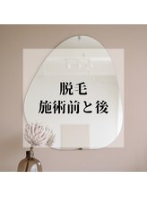 ティンクル サロン(Twinkle salon)/脱毛の施術前後