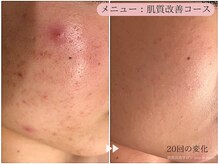 レスイズモア 恵比寿(less is more.)の雰囲気（東京のおすすめサロンで雑誌掲載!［ニキビケア/肌質改善/毛穴］）