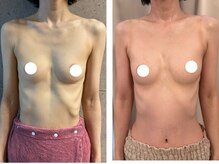 ハイファイブ(Hi-Five)/バストアップ/（施術6回）