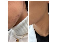 リーフィ 荻窪(Leafy)/ハーブピーリング