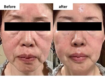 オワゾーブルー(Oiseaubleu)/シワ・たるみの改善例