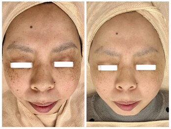 ポモナ 横浜馬車道店(Pomona)/シミはもちろんくすみも大変身