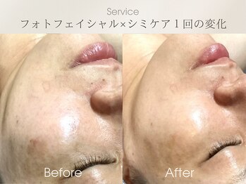 フェイシャルサロン ベルダ(BELDA)/【長年のシミを改善】