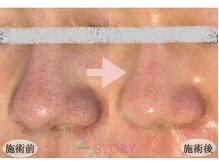 ストーリー(STORY)/眉毛と艶肌ワックス専門店