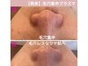 【再来・2回目まで】毛穴集中プラズマケア★ツヤ肌へ￥22,000→￥15,900