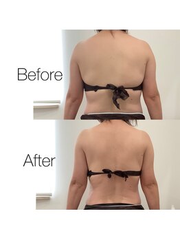 レスプロンディール(Resplendir)/骨盤矯正&痩身機器