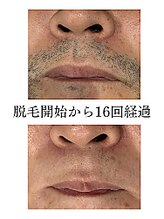 アンジェリーナ/ヒゲ脱毛/16回経過/都度払い