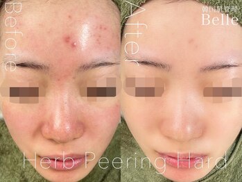 ベル 錦糸町(Belle)/ハーブピーリング|ニキビケア