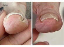 ロンディネ(Rondine)/巻爪ケア7