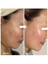 ココ(COCO)/ハーブピーリング/REVI/高知