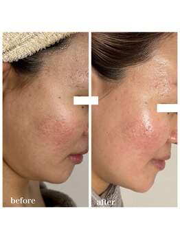 ココ(COCO)/ハーブピーリング/REVI/高知