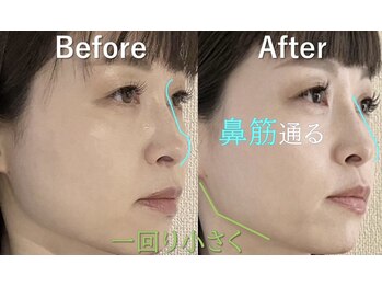 ラプリエイル 千葉店(Raplit aile)/隆鼻+輪郭・小顔矯正40分 10回