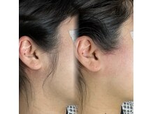 サロンロン 横浜関内(SALON RON)の雰囲気（もみあげのムダ毛脱毛でスッキリ綺麗な横顔美人！！）