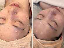 ルーチェ(Luce)/セルマンピーリング