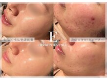 シューラディアント(ShuRadiant)の雰囲気（エンビロン正規品取扱店／レチノール導入で毛穴やニキビ改善）