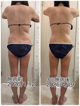 クールスパ(COOL SPA)/40代背中症例