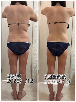 クールスパ(COOL SPA)/40代背中症例