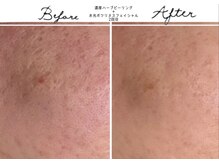 アリュール 倉敷(ALLURE)の雰囲気（水光ボツリヌスとの組み合わせで更に早い改善に☆）