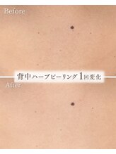 サロンベイア(salon Beia)/背中ハーブピーリング1回変化♪