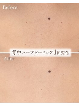 サロンベイア(salon Beia)/背中ハーブピーリング1回変化♪