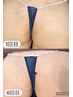 【お尻のザラつき・古い角質に】ハーブピーリング初回￥11000